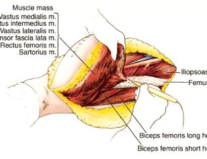 Quads Tumor Removal