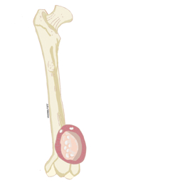 Radical Resection of Bone Tumors