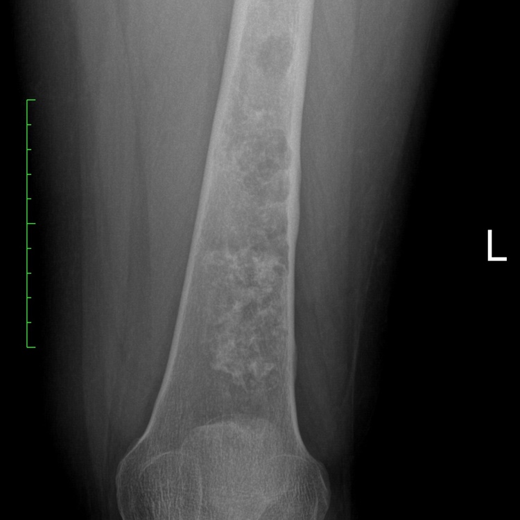 7A) Chondrosarcoma Case 1 Plain AP X Ray Of The Left Femur JW2