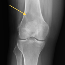 Undifferented Pleomorphic Sarcoma (UPS)