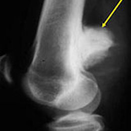 Parosteal Osteosarcoma