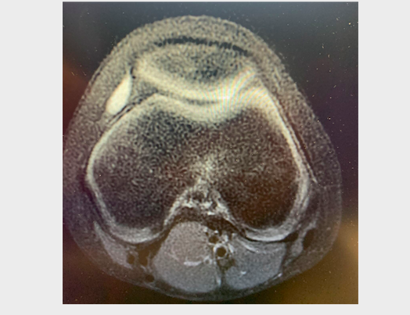 Another interesting case! Cyst or Synovial Sarcoma in this 10 year old child?