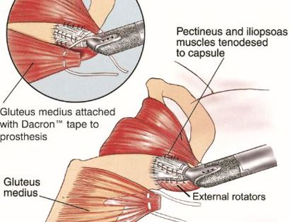 Capsule Closure 