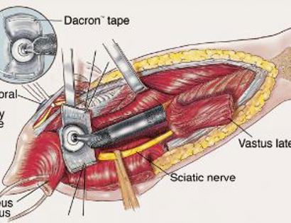 Soft Tissue Coverage 