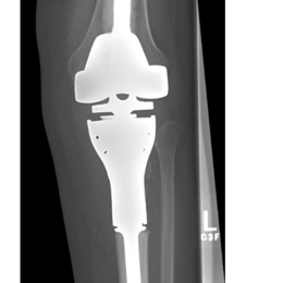 Proximal Tibia Tumor Prosthesis Replacement