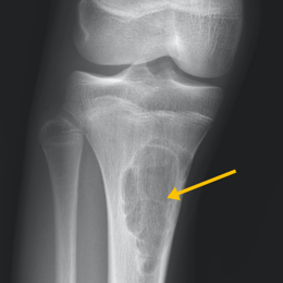 Non Ossifying Fibroma