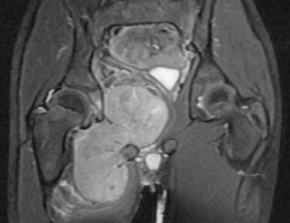 Adductor Compartment MRI