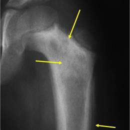 Ewing's Sarcoma