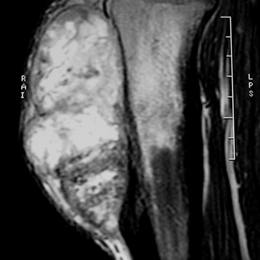 24C) Sag MR T2 Periosteal Osteosarcoma