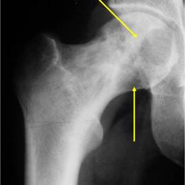 Clear Cell Chondrosarcoma