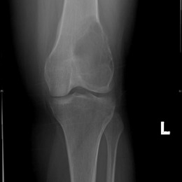 Giant Cell Tumor