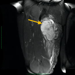 Fibrosarcoma