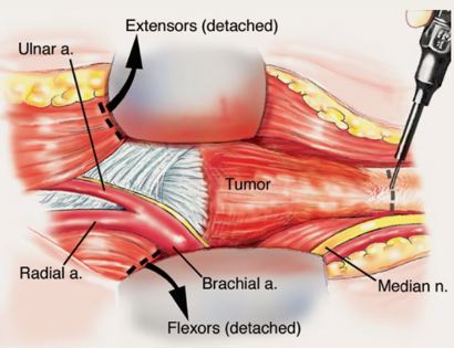 Blood Vessel and Nerve Dissection