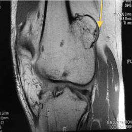 Osteochondroma