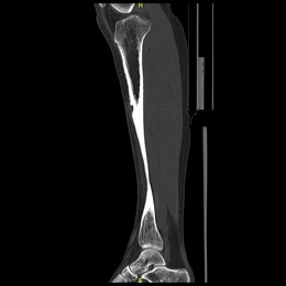 38E) Sagittal CT Of Right Tibia Osteoblastoma