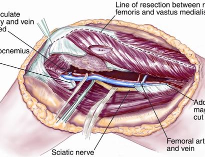 Blood Vessel and Nerve Dissection 