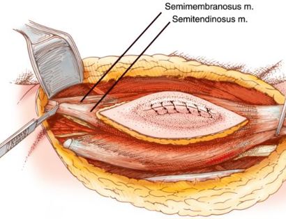 Tumor Removal 