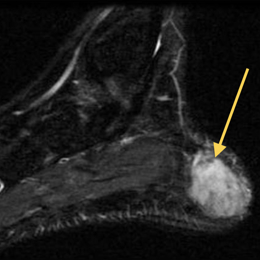 Clear Cell Sarcoma