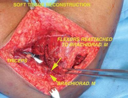 Soft Tissue Coverage 