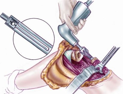 Distal Femur Reaming 