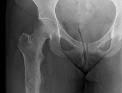 Proximal Femur Xray Photo Tumor