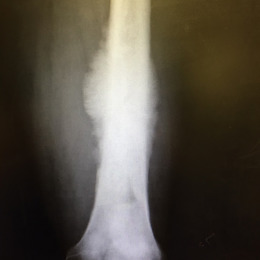 Osteosarcoma Diaphyseal