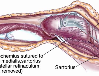 Soft Tissue Coverage 2