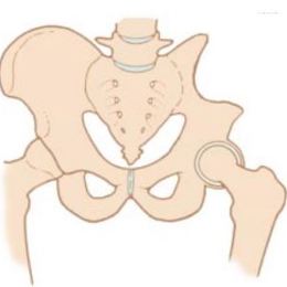 Pelvic Tumor Removal