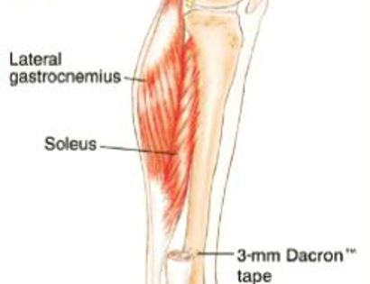 Tumor Removal and Reconstruction 