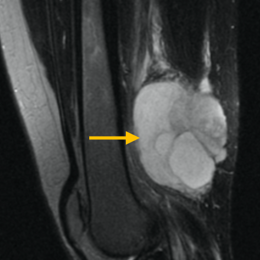 Pleomorphic Liposarcoma