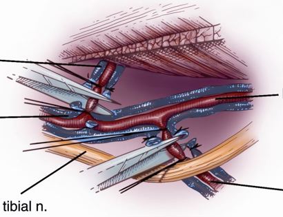 Vessel Ligation 