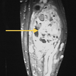 Hemangiopericytoma of Soft Tissue