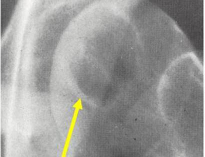 X-Ray of Clear Cell Chondrosarcoma