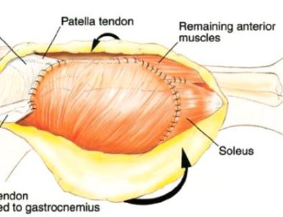 Soft Tissue Coverage 