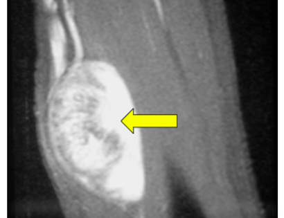 Pre-Op MRI of Tumor