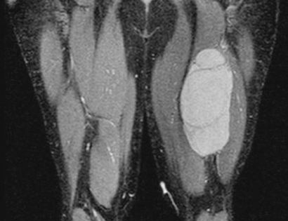 MRI of hamstrings tumor 