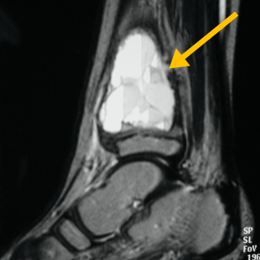 Aneurysmal Bone Cyst