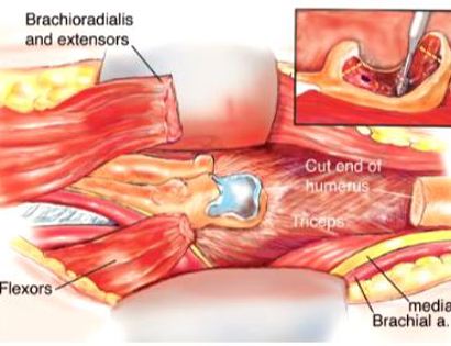 Tumor Removal and Reconstruction 