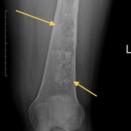 Conventional Chondrosarcoma