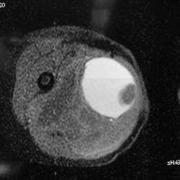 Rhabdomyosarcoma