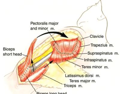 Soft Tissue Coverage 