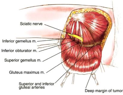 Tumor Removal 