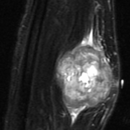 Leiomyosarcoma