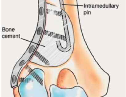 Bone Grafting and Fixation