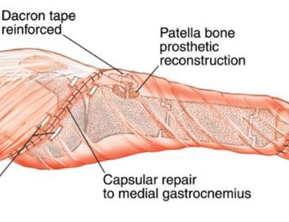 Soft Tissue Coverage 