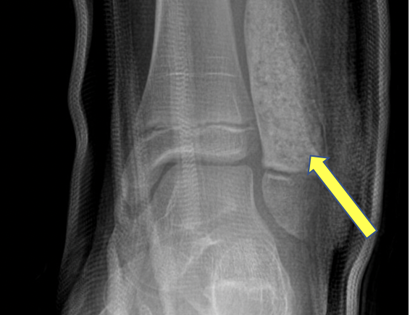 Bone Grafting and Fixation