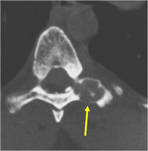 Osteoblastoma26