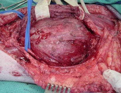 Intra-Op: Blood Vessel and Nerve Dissection