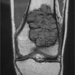 Giant Cell Tumor