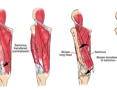 Muscles transferred 